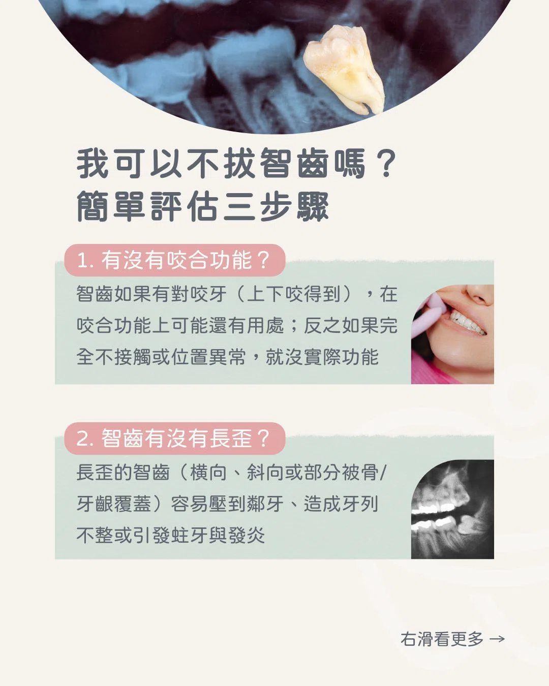 其實智齒不一定要拔?!