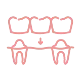 全口重建 (All on 4/6)